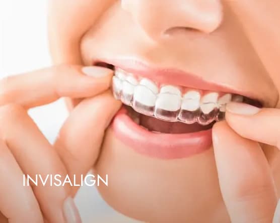 Invisalign